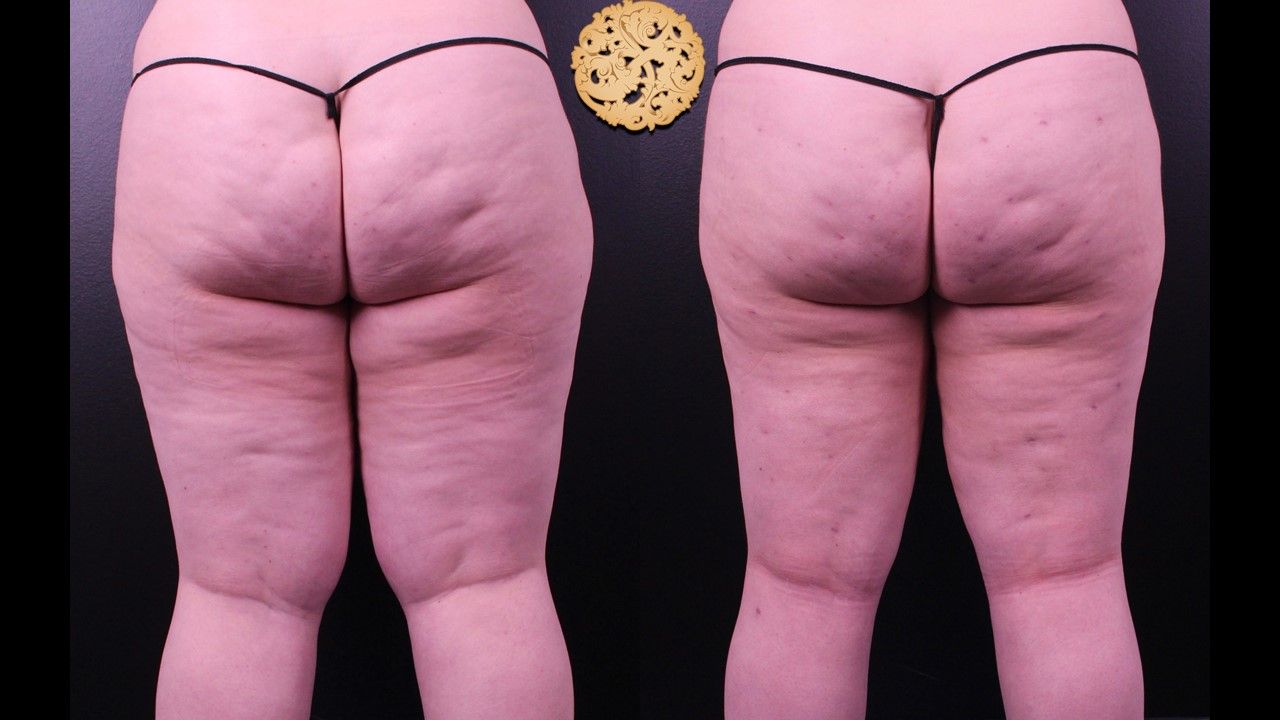 Liposuction Legs Before & After