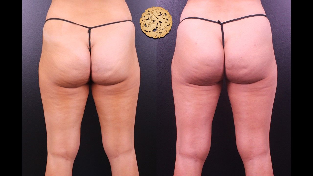 Liposuction Legs Before & After