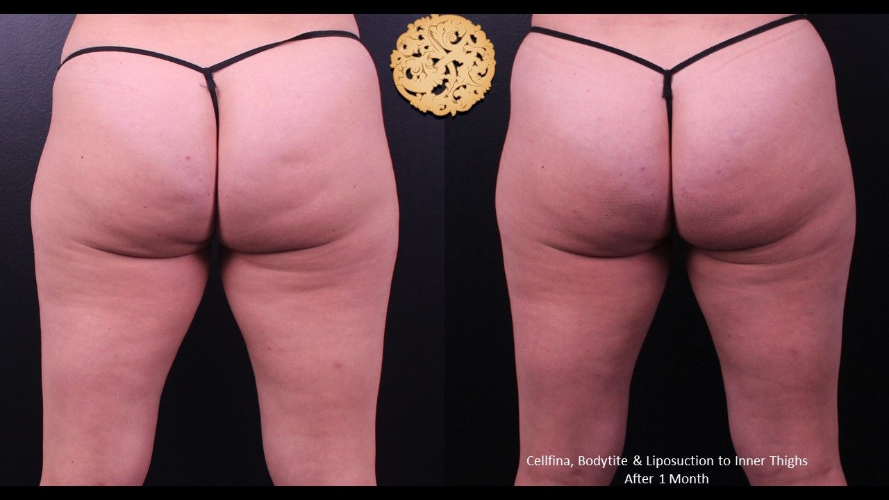 Liposuction Legs Before & After