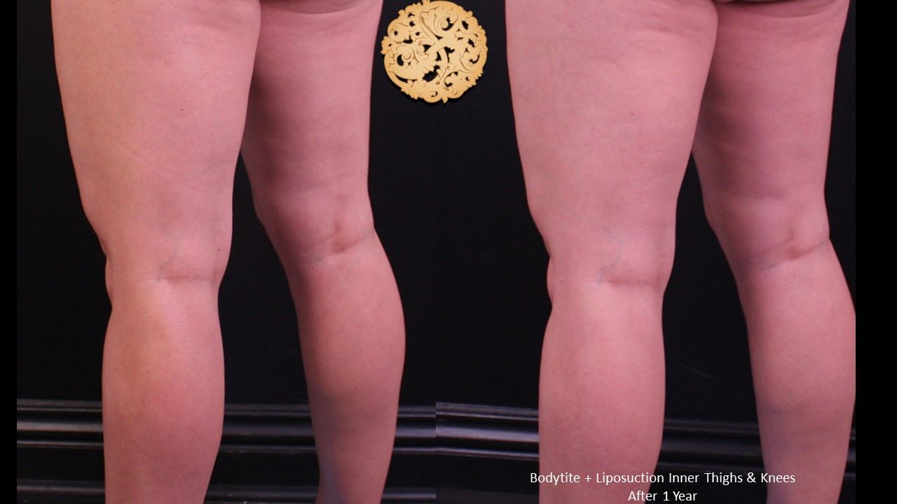 Liposuction Legs Before & After
