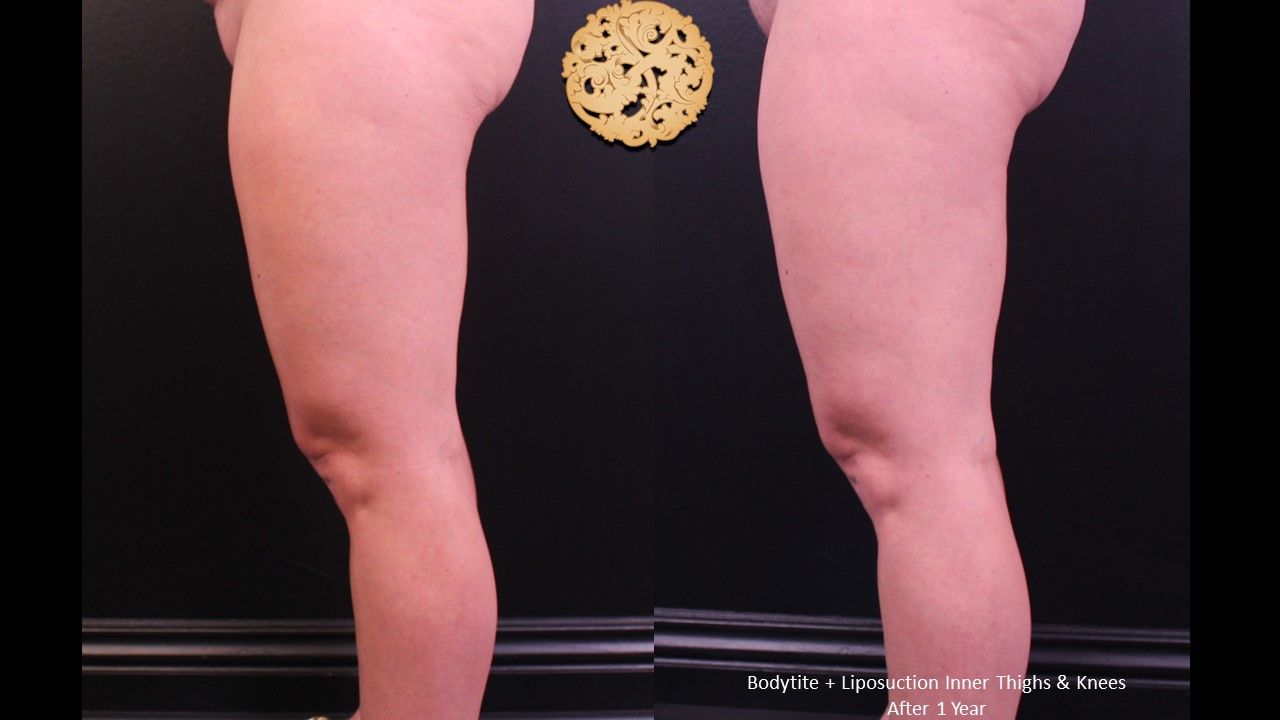 Liposuction Legs Before & After
