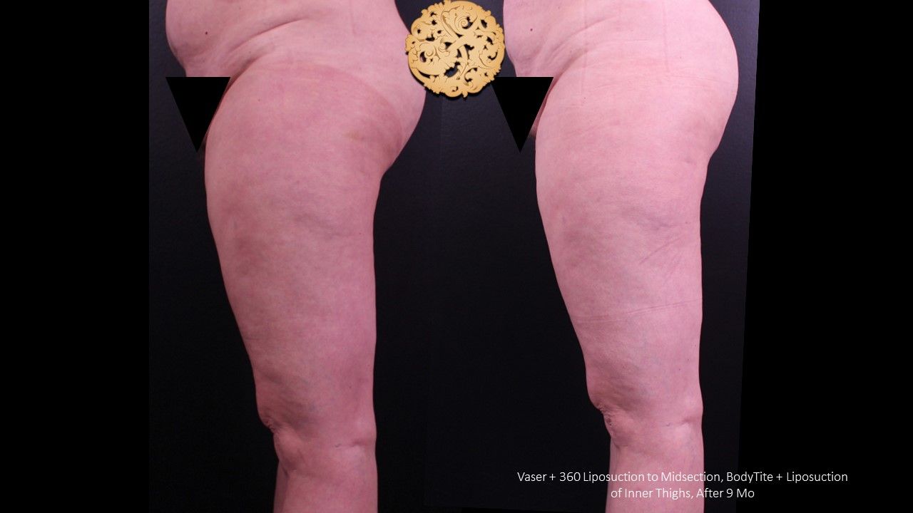 Liposuction Legs Before & After