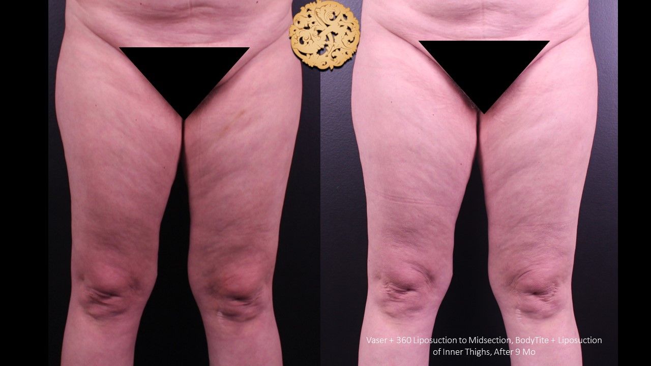 Liposuction Legs Before & After