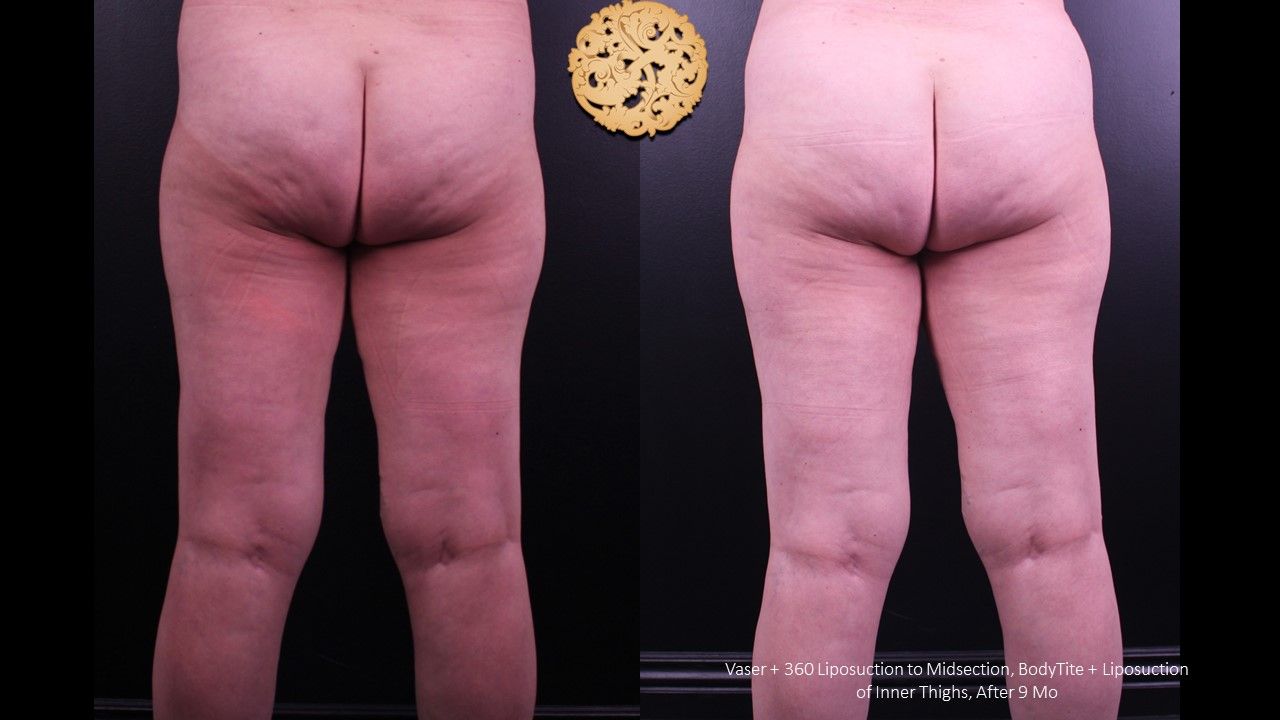 Liposuction Legs Before & After