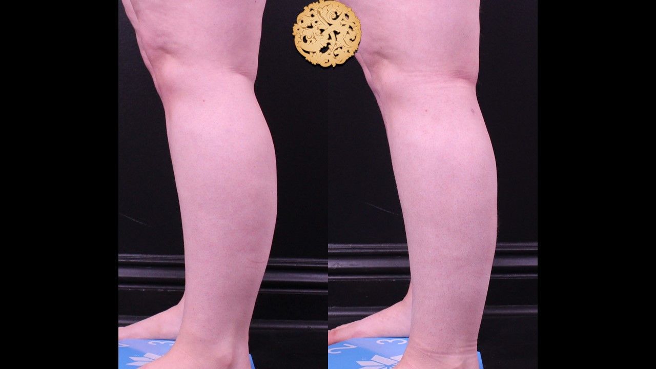 Liposuction Legs Before & After
