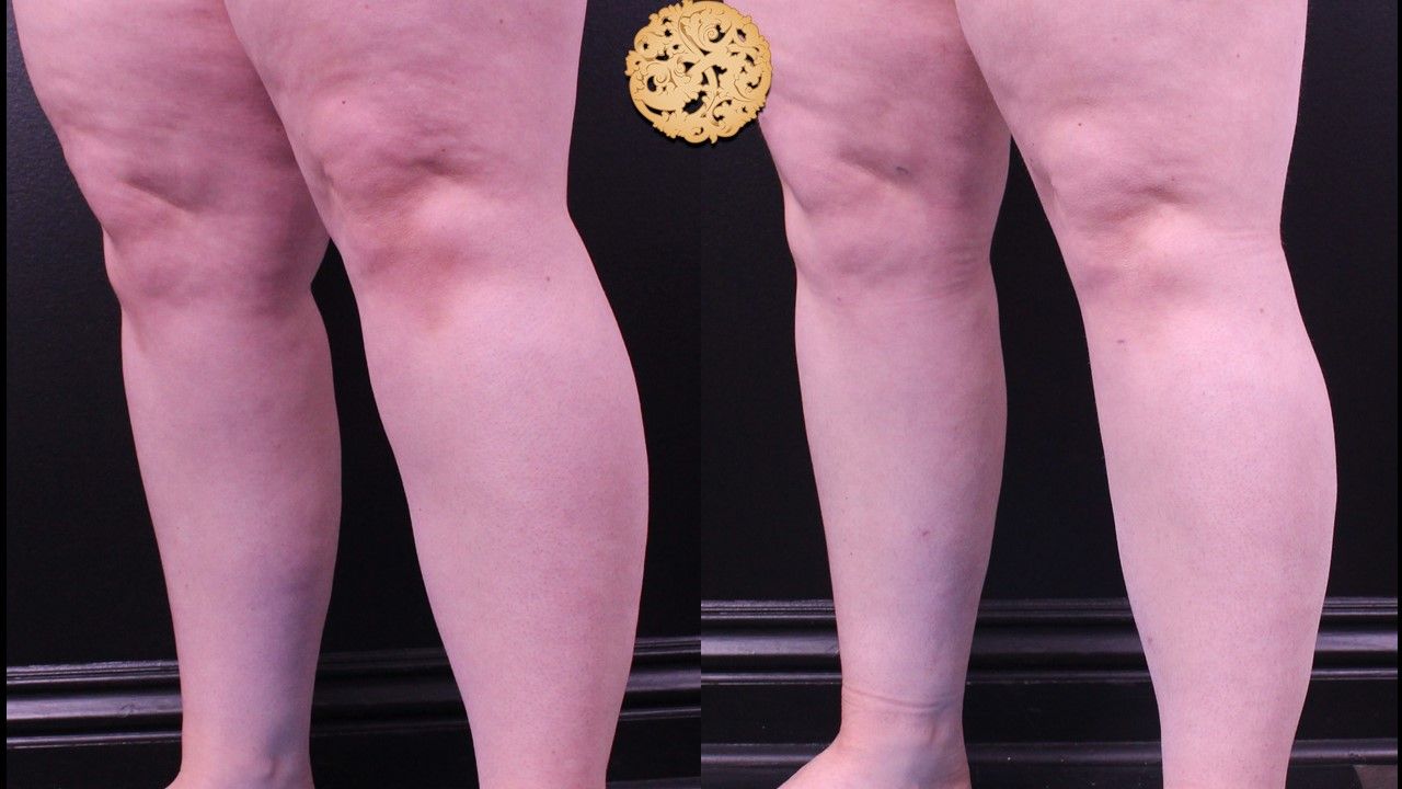 Liposuction Legs Before & After