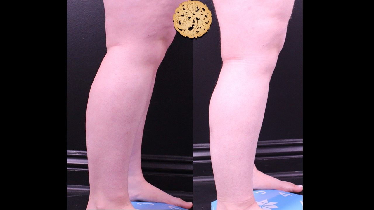 Liposuction Legs Before & After