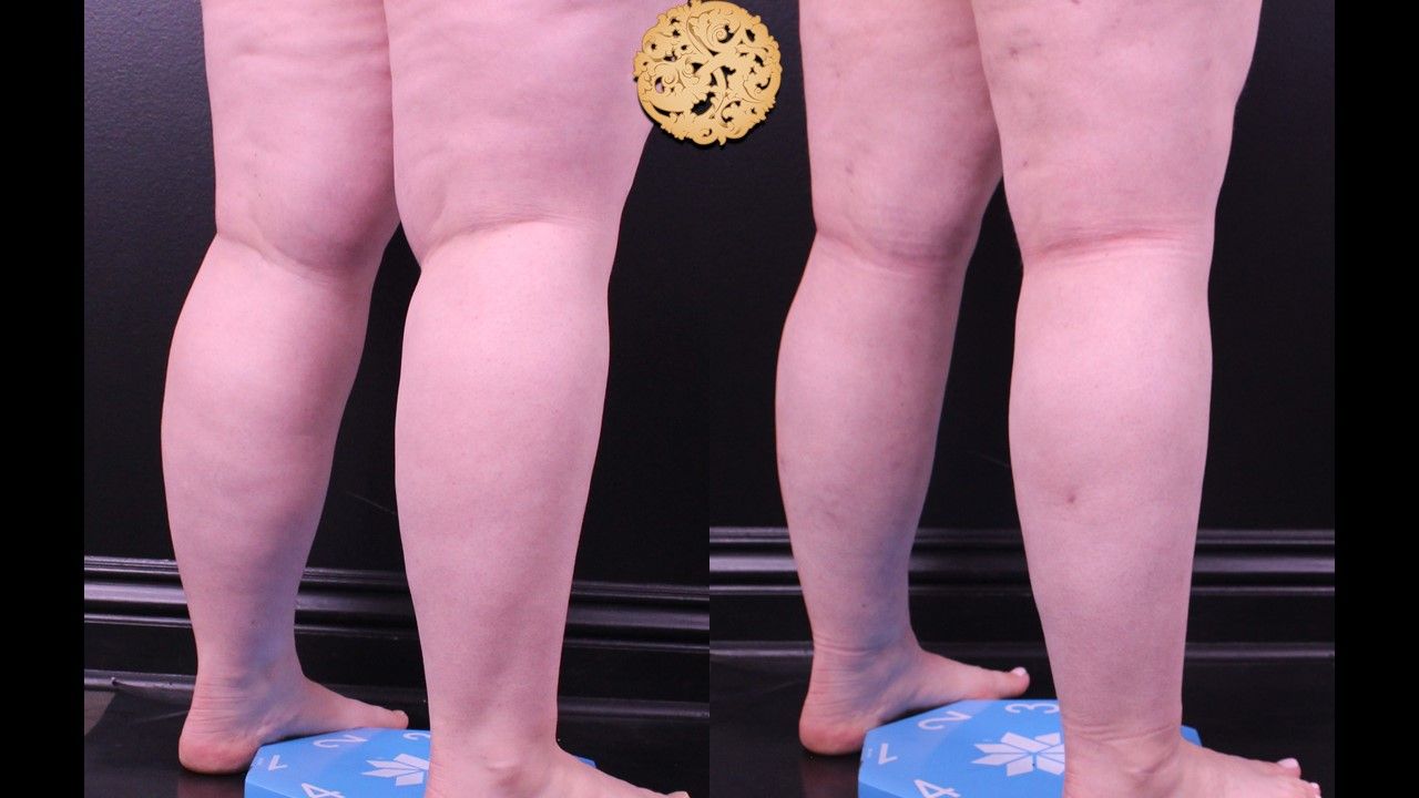 Liposuction Legs Before & After