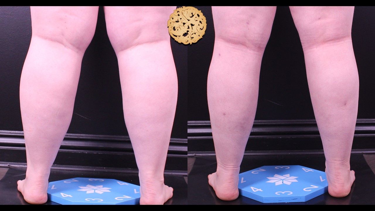 Liposuction Legs Before & After
