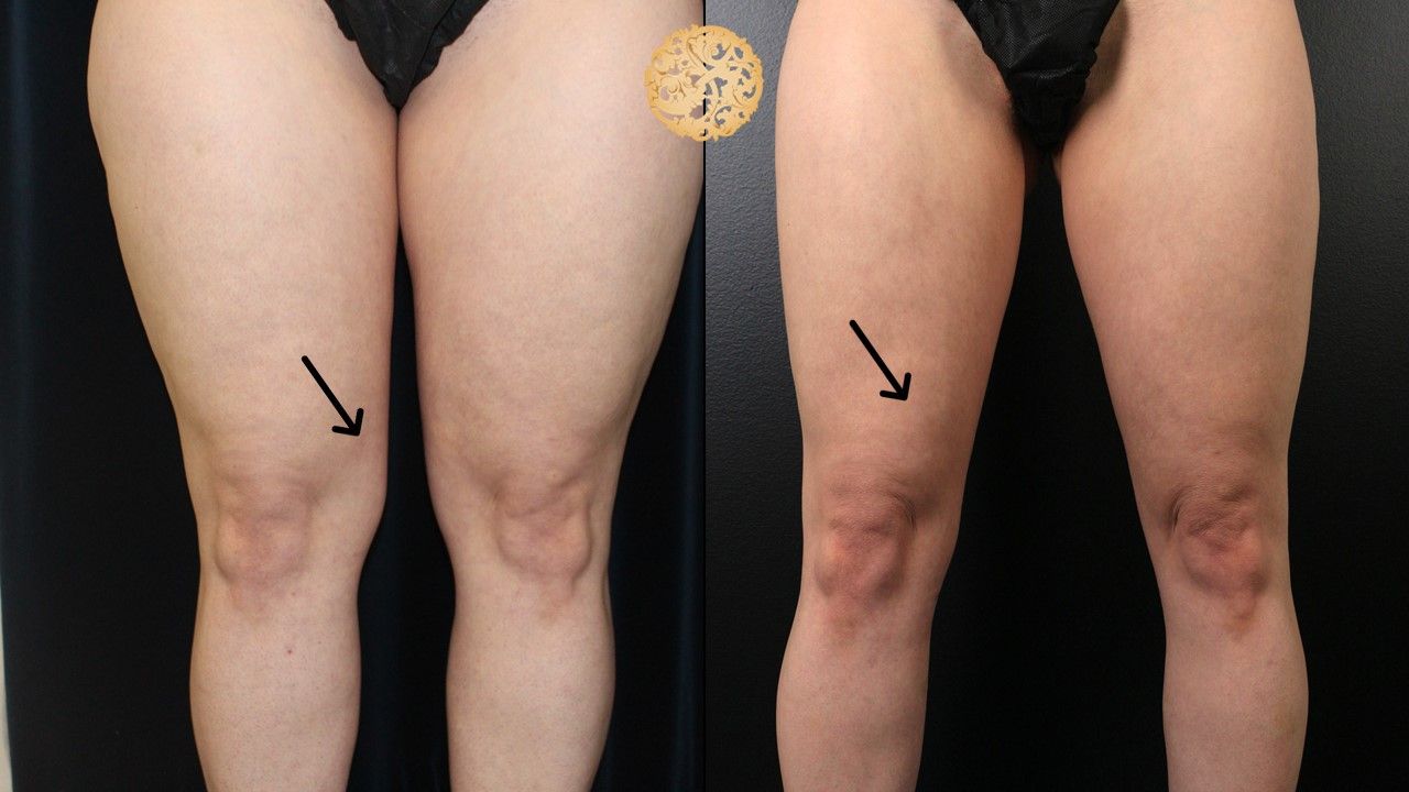 Liposuction Legs Before & After