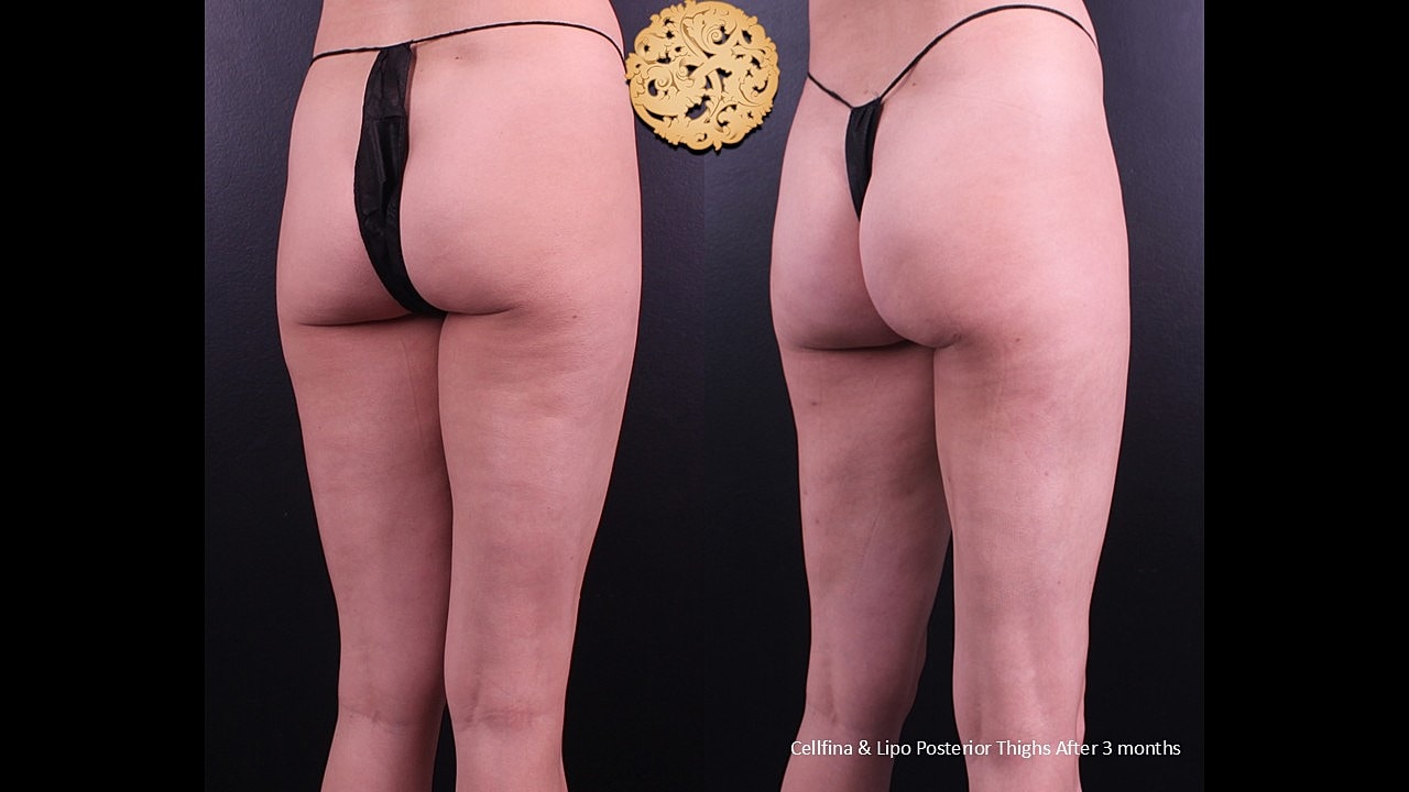 Lipo Posterior thighs & Cellfina After 3 months