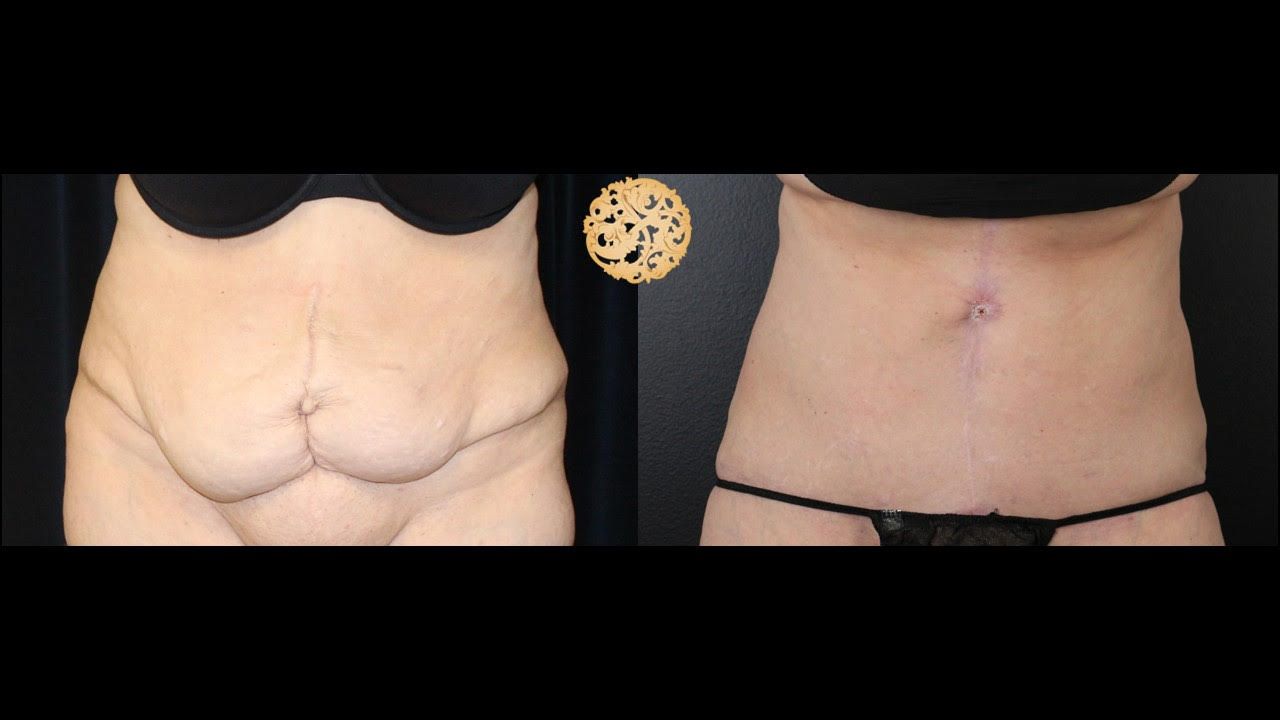 Belly Button Surgery Before & After