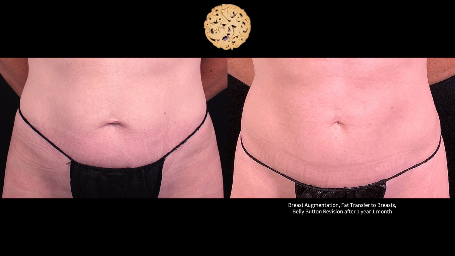 Belly Button Surgery Before & After