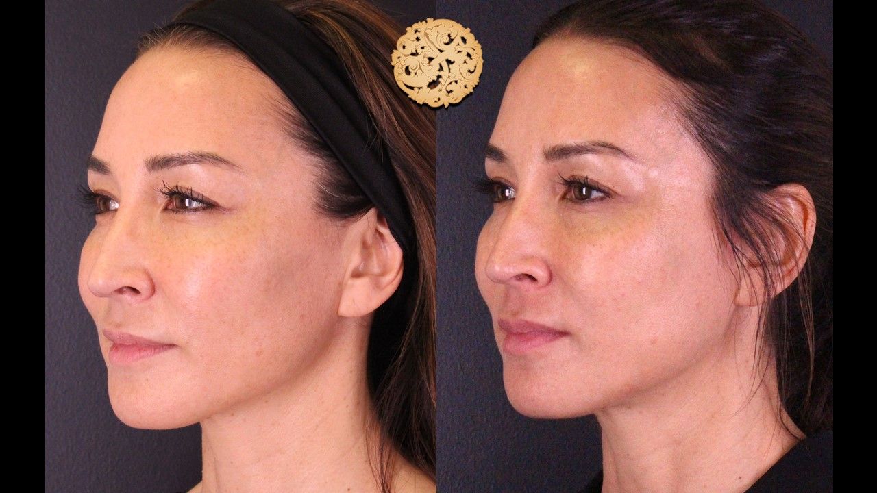 Dermapen Microneedling Before & After