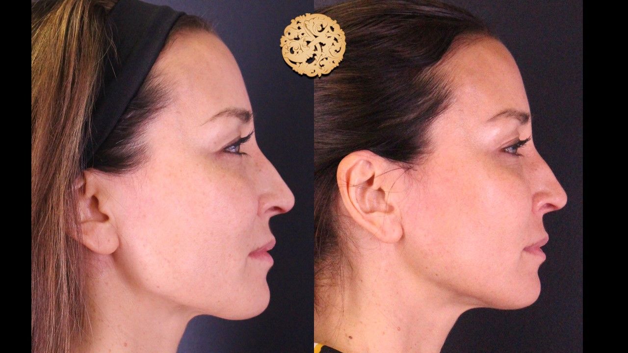 Dermapen Microneedling Before & After