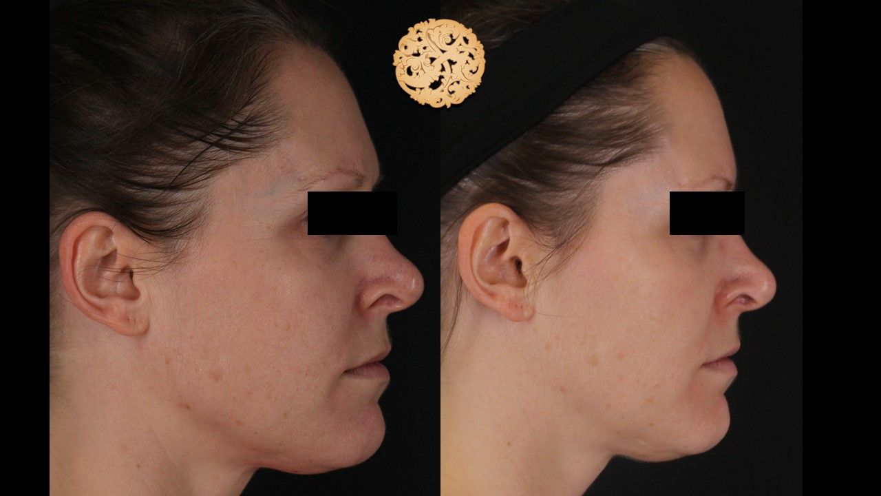 Dermapen Microneedling Before & After