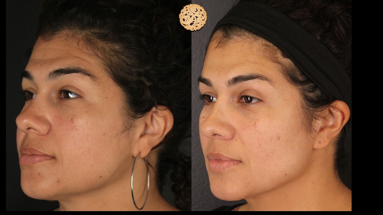 Dermapen Microneedling Before & After