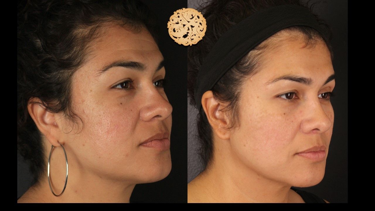 Dermapen Microneedling Before & After