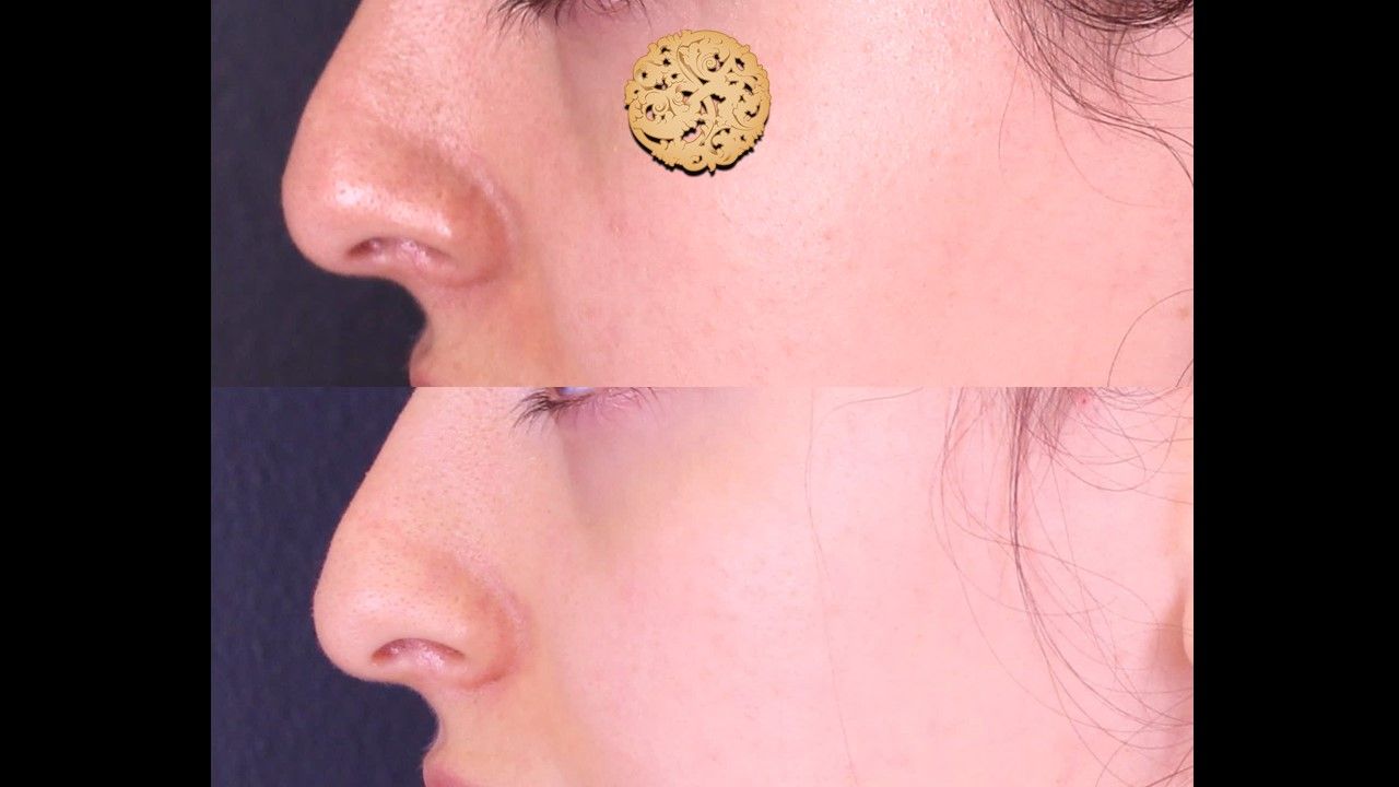 Dermapen Microneedling Before & After