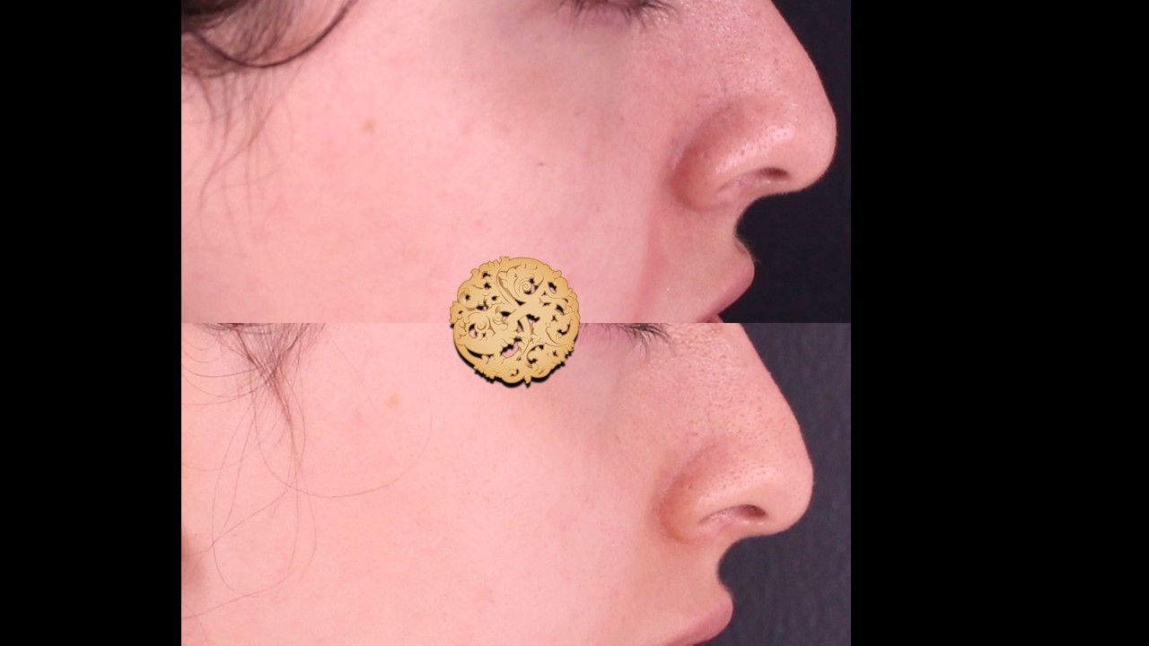 Dermapen Microneedling Before & After