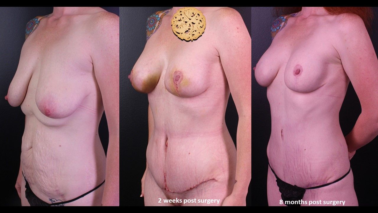 Mommy Makeover Before & After