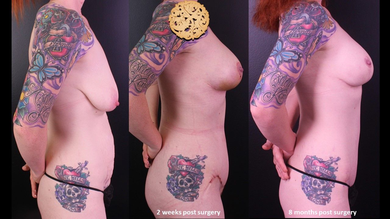 Mommy Makeover Before & After