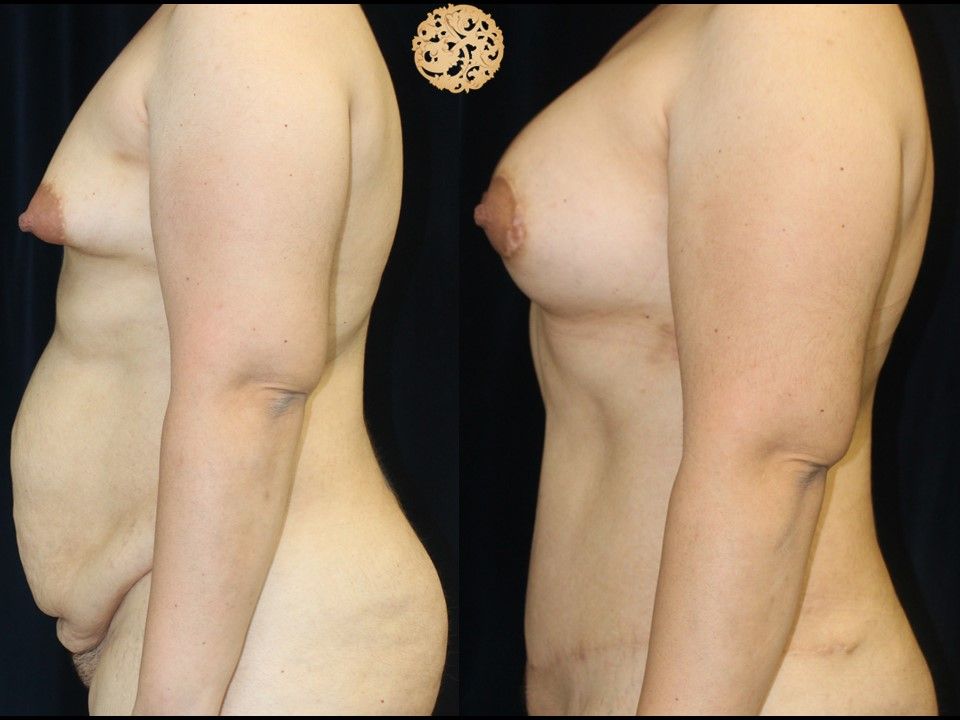 Mommy Makeover Before & After