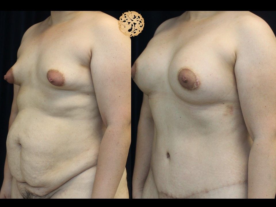 Mommy Makeover Before & After