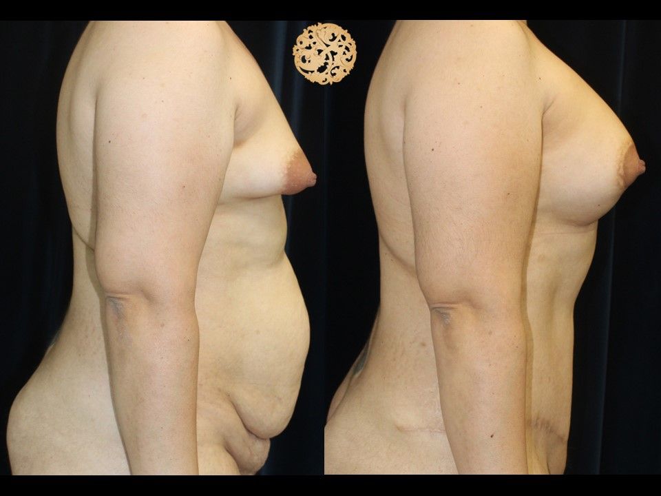 Mommy Makeover Before & After