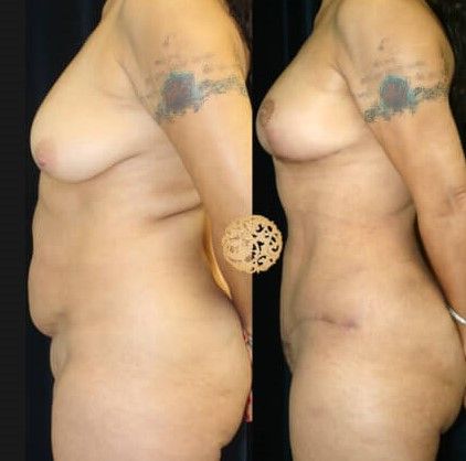 Mommy Makeover Before & After