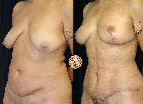 Mommy Makeover Before & After