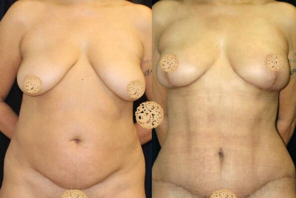 Mommy Makeover Before & After