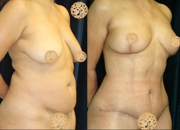 Mommy Makeover Before & After