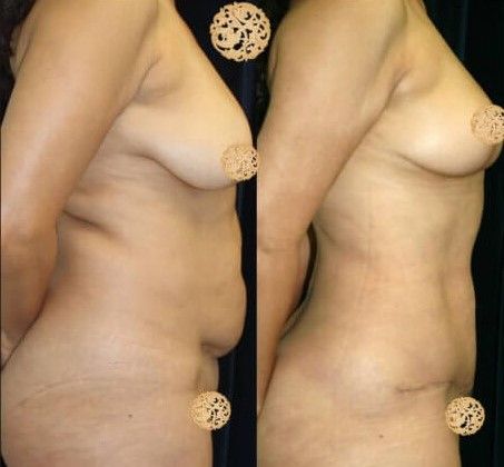 Mommy Makeover Before & After