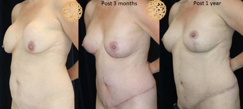 Mommy Makeover Before & After