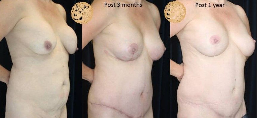 Mommy Makeover Before & After