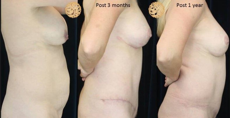 Mommy Makeover Before & After