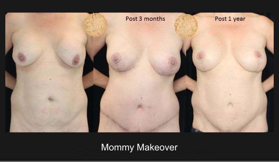 Mommy Makeover Before & After