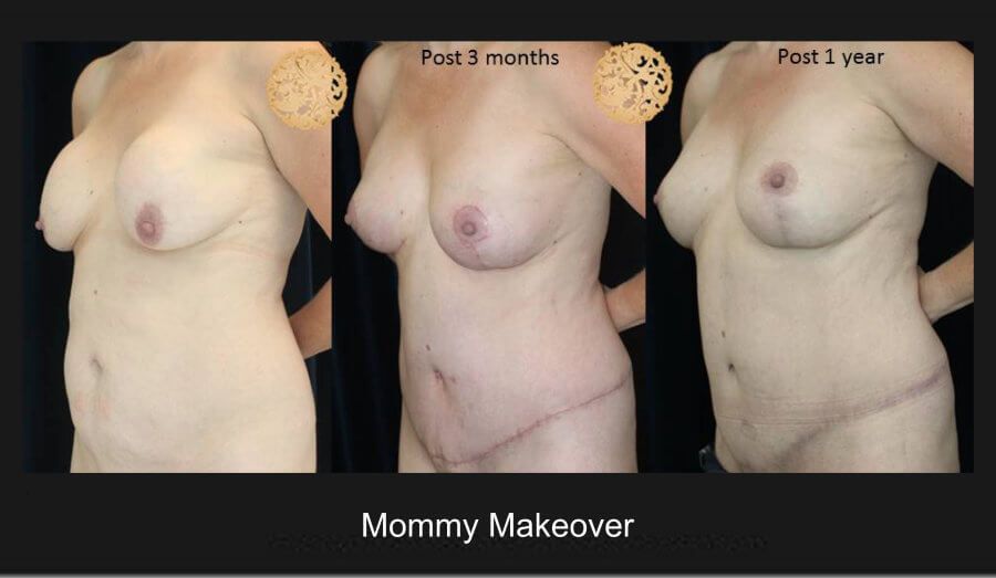 Mommy Makeover Before & After