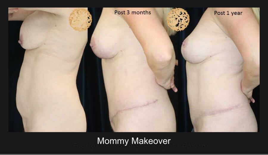 Mommy Makeover Before & After