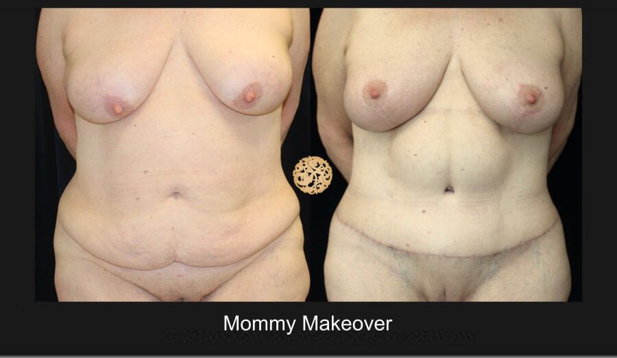 Mommy Makeover Before & After