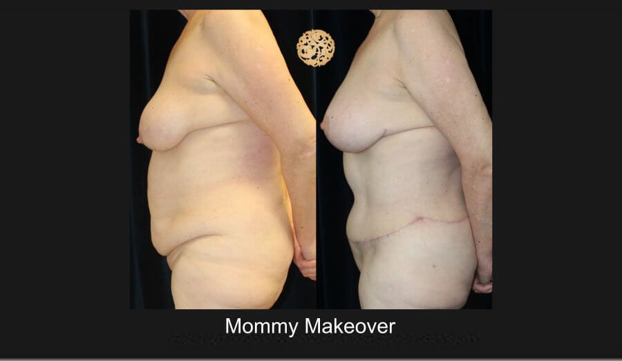 Mommy Makeover Before & After