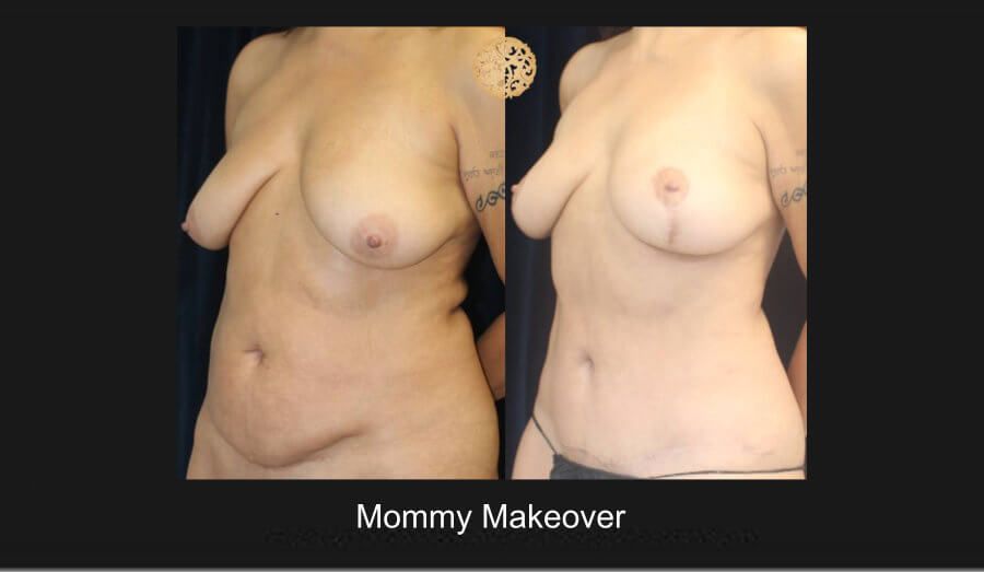 Mommy Makeover Before & After
