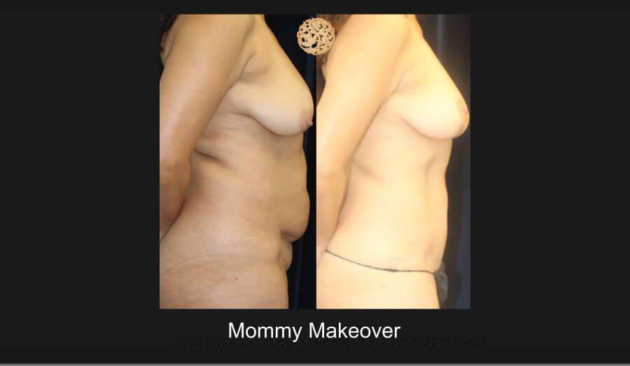 Mommy Makeover Before & After