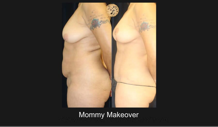 Mommy Makeover Before & After