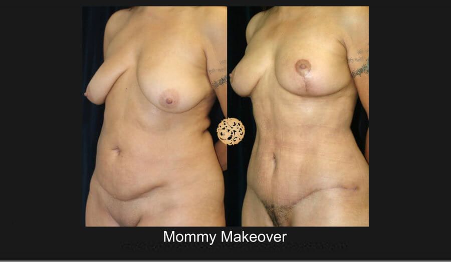 Mommy Makeover Before & After