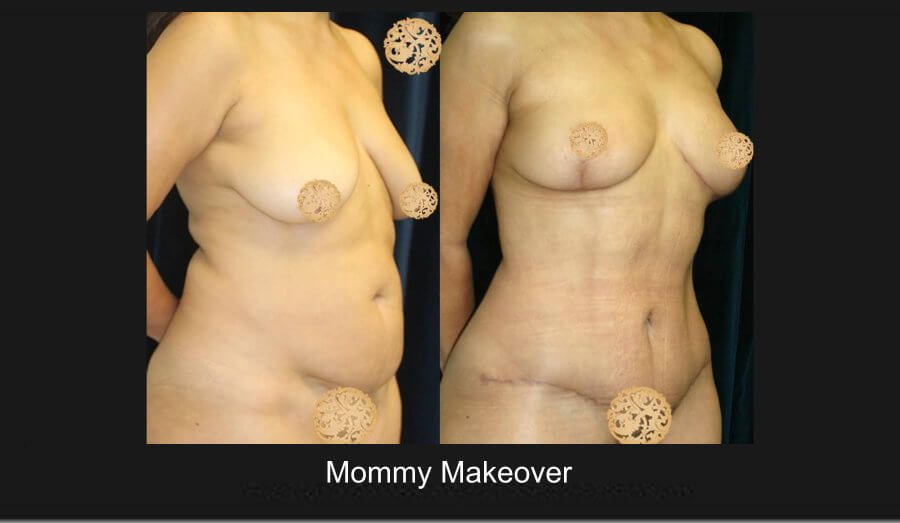 Mommy Makeover Before & After