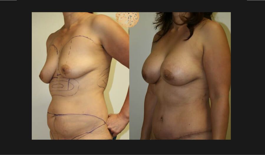 Mommy Makeover Before & After