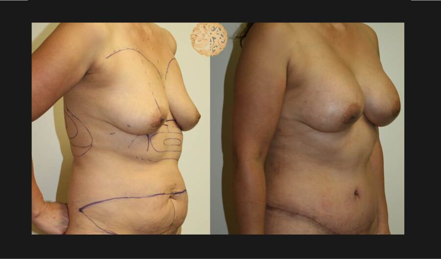 Mommy Makeover Before & After