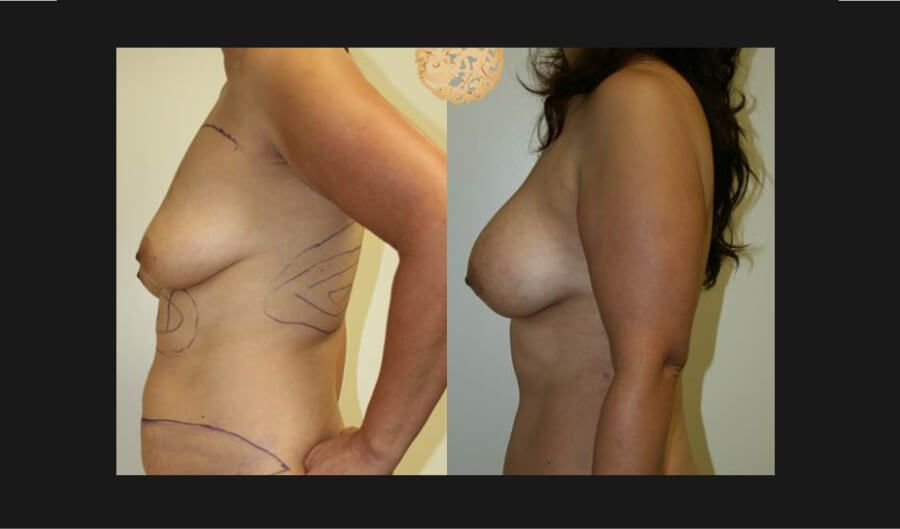 Mommy Makeover Before & After